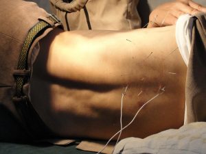 Home Acupunctuur behandeling in Alkmaar met traditionele Chinese geneeswijze naalden op ontspannende therapeutische sessie